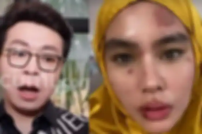 Richard Lee tanggapi ruam di wajah Kartika Putri