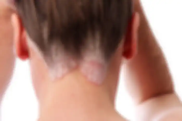 Hingga saat ini, penyebab psoriasis belum dapat dipastikan. Namun, penyakit kulit ini dianggap berhubungan dengan kekebalan tubuh atau otoimun.