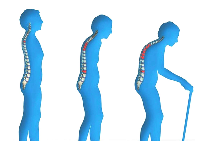 Seiring bertambahnya umur, maka risiko mengalami penyakit degeneratif pun semakin besar , salah satunya osteoporosis.