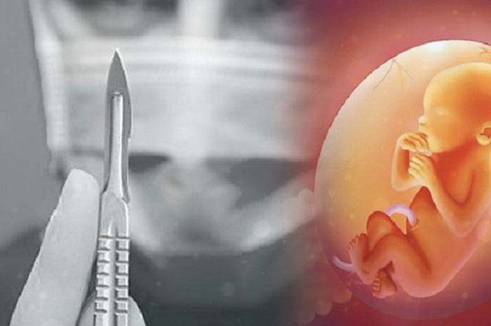 Ilustrasi Aborsi