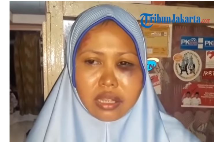 Nur Azizah menunjukkan luka lebam di wajahnya saat TribunJakarta.com menyambangi kediamannya.