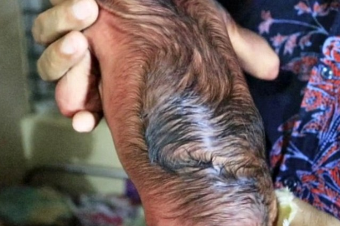 Bagian punggung bayi yang ditumbuhi rambut lebat