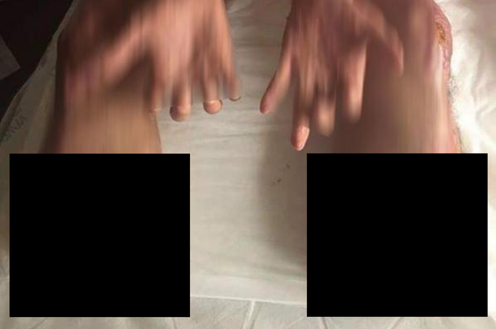 Pria ini harus mengamputasi kakinya karena infeksi parah akibat santap olahan darah babi.