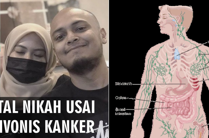 Kita perlu mengetahui bagaimana gejala dan ciri kanker kelenjar getah bening atau limfoma yang umumnya terjadi.