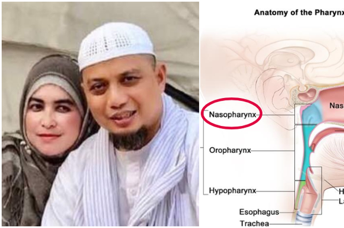 Almarhum ustaz Arifin Ilham meninggal karena kanker nasofaring yang ternyata banyak terjadi di Asia Tenggara, gejalanya hidung tersumbat.
