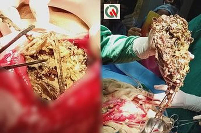 Berbagai macam koin dan perhiasan bernilai lebih dari Rp924 juta ditemukan di perut seorang wanita dan membuat dokter heran.