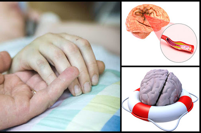 Perawatan Alami dan Alternatif Untuk Stroke