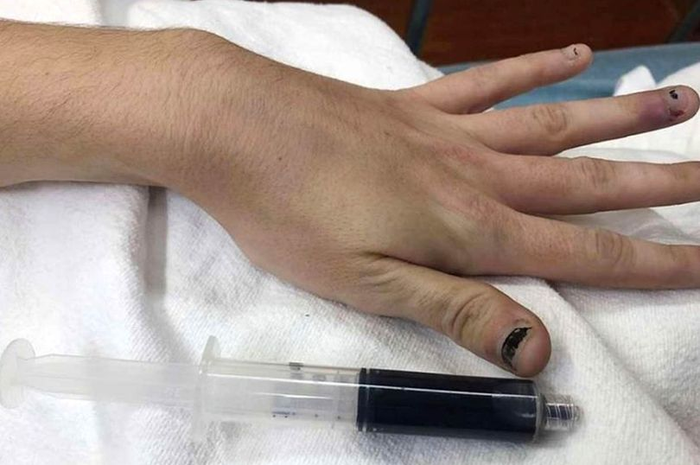 Sampai di rumah sakit, dokter memeriksanya, dan menemukan darah wanita 25 tahun itu juga berubah menjadi berwarna biru.