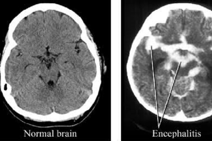 Perbedaan otak normal (kiri) dan yang terkena encephalitis (kanan).