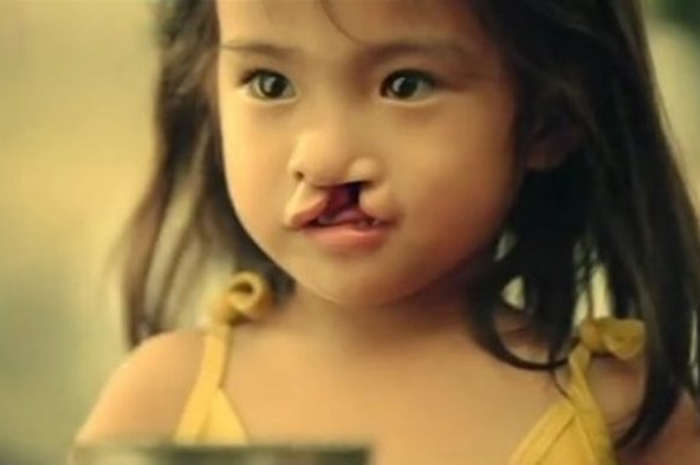 Anak ini terlahir bibir sumbing dan dibuang orangtuanya, namun lihat penampilannya setelah dewasa dan sukses.