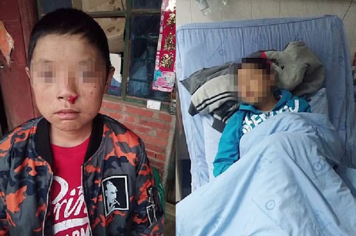 Seorang bocah lelaki asal China diketahui memiliki kondisi darah langka yang disebut sebagai 'penyakit drakula.'