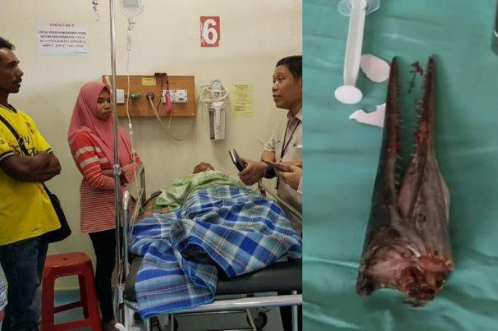 Moncong ikan sori alais marlin usai dikeluarkan melalui operasi dari leher remaja kelas 2 SMP Muhammad Idul di RSUP Dr. Wahidin Sudirohusodo Makassar, Senin (20/1/2020).(Istimewa)