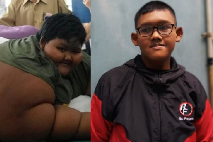 Arya Permana, bocah yang dulu memiliki berat badan 190 kilogram, kini beratnya sudah menjadi 83 kilogram.