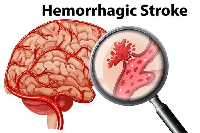Ternyata satu bulan sebelum stroke tubuh akan mengirimkan tanda peringatan ini. Kenali jangan sampai merenggut nyawa