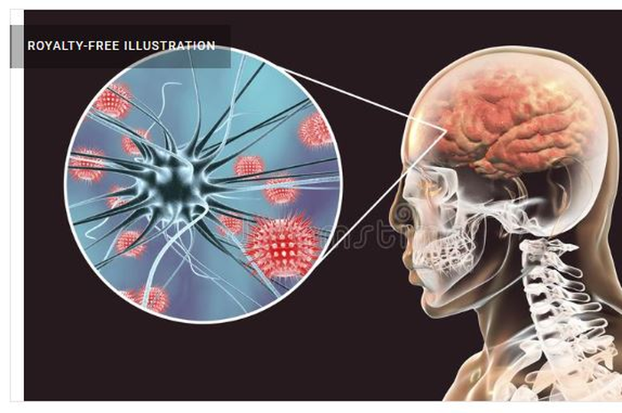 Ilustrasi Meningitis