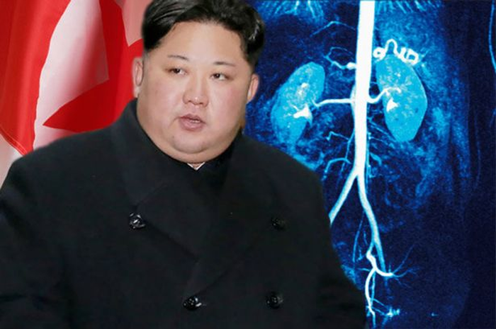 Terkait penyakit jantung, faktanya keluarga pemimpin Korea Utara KIm Jong Un memiliki sejarah penyakit ini