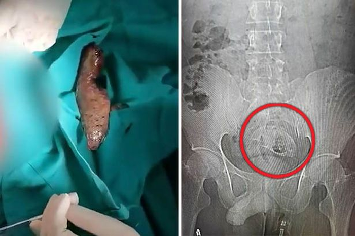Seekor ikan terjebak di dalam pantat seorang pria.