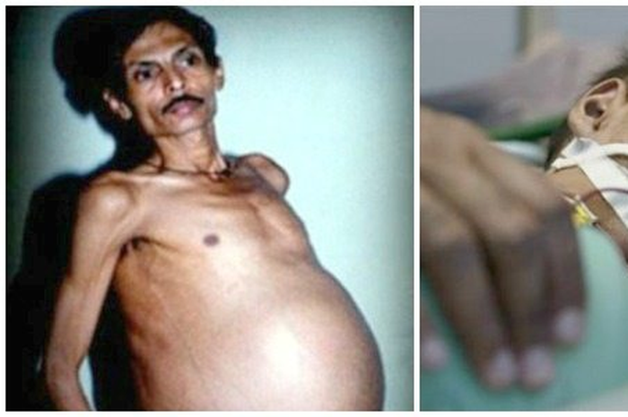 Orang-orang desa di tempat tingganya sempat mengejek Bhagat, mengatakan bahwa dirinya hamil, dan ironisnya ucapan mereka terbukti benar.