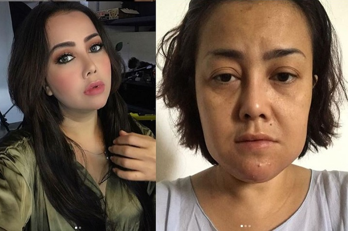 Rency Milano Diduga Jadi Korban Malpraktik Klinik Kecantikan