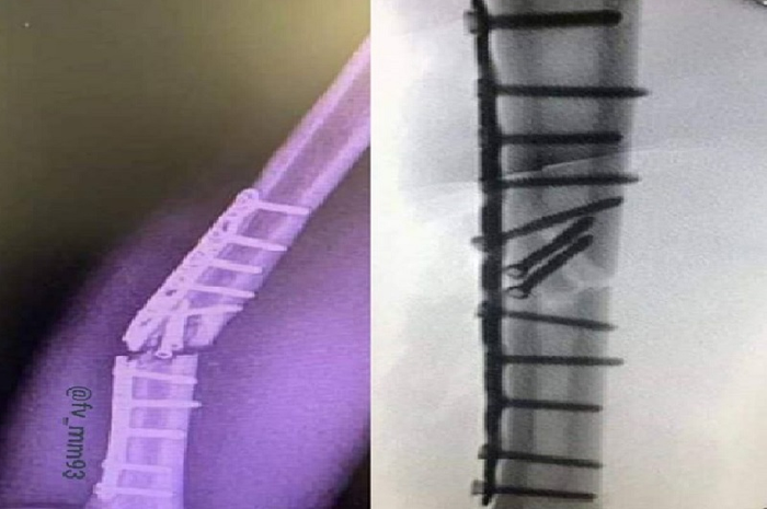 Beredar foto kondisi pelat titanium yang ditanam di tangan pembalap Repsol Honda, Marc Marquez yang patah sebelum operasi kedua.