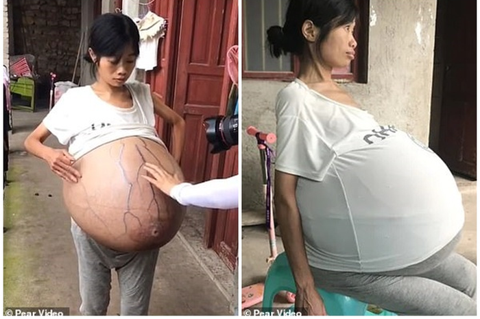 Perutnya terus tumbuh setiap hari, dia juga merasakan kesakitan sehingga pergi ke dokter untuk mendapatkan perawatan.