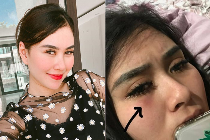 Syahnaz Sadiqah tetiba pamer potret menangis, mata bagian bawah bengkak dan memar, ada apa?
