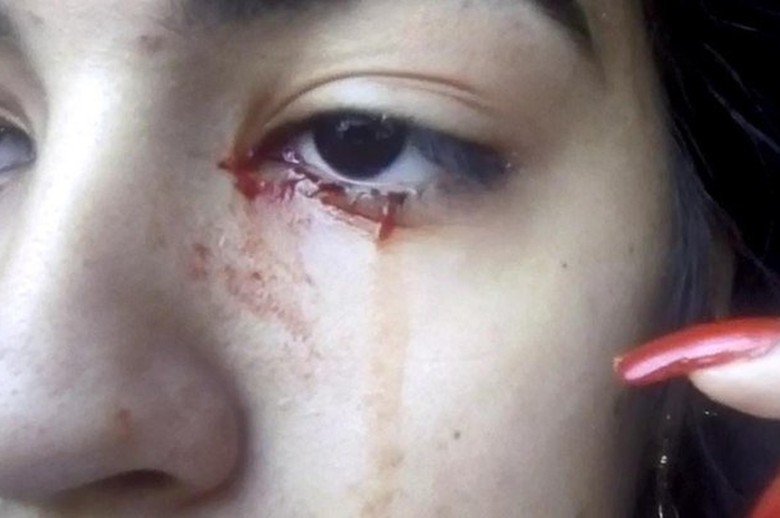 Gadis remaja diduga menangis darah.