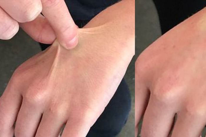 Cubit punggung tangan