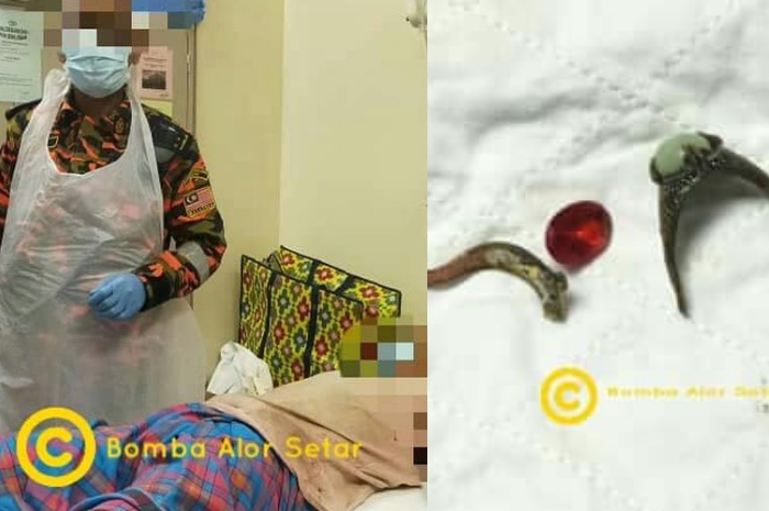 2 cincin tersangkut di kelamin suami