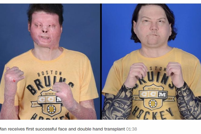 Joe DiMeo (22) menjalani transplantasi wajah dan tangan ganda pertama di dunia