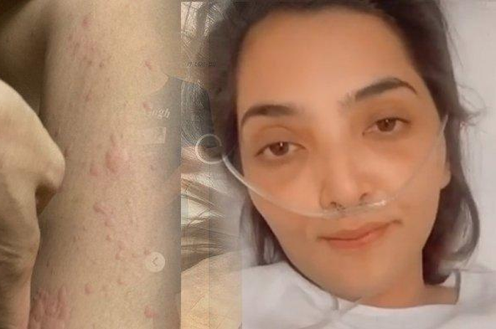 Ashanty kembali alami autoimun jelang pernikahan Atta Halilintar dan Aurel Hermansyah