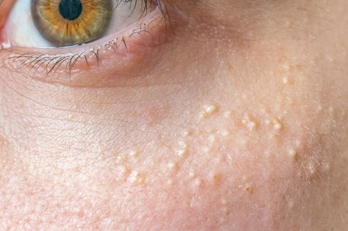 Skincare untuk atasi milia pada kulit sekitar mata.