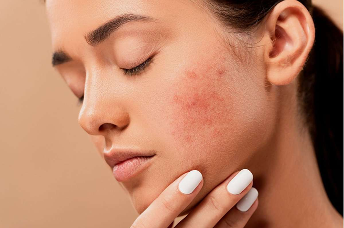 Ilustrasi skin barrier rusak