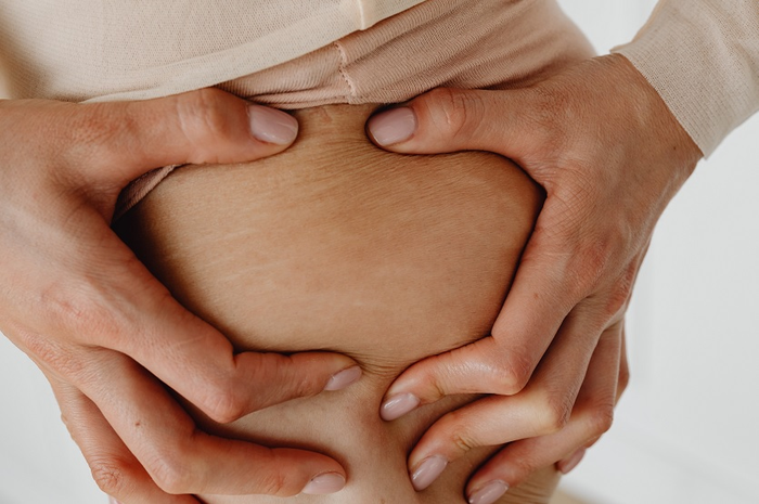Ilustrasi stretch mark.