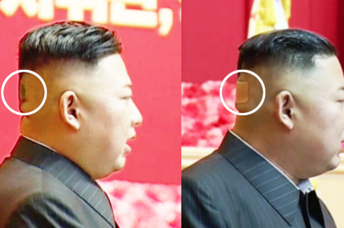 Senin (2/8/21), pemimpin Korea Utara Kim Jong Un muncul dengan bintik hitam di bagian belakang kepalanya selama kegiatan publik pekan lalu.