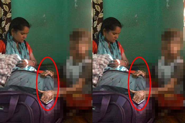 Bocah 16 tahun ini terlahir dnegan kulit mirip ular