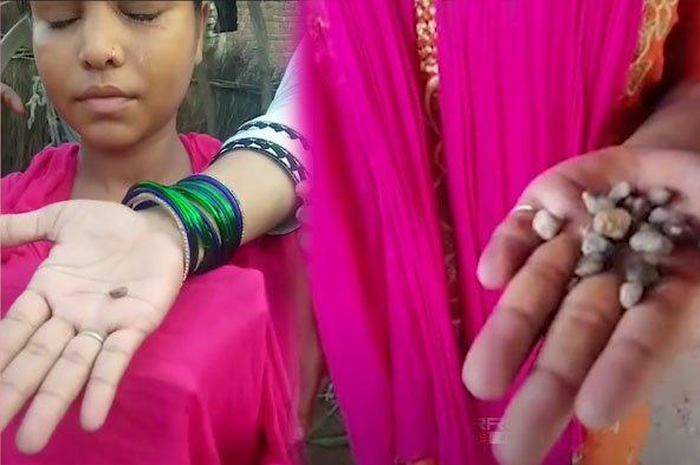 Chandhi, gadis 15 tahun di Negara Bagian Uttar Pradesh, India, yang menjadi viral karena mengeluarkan batu, alih-alih air mata