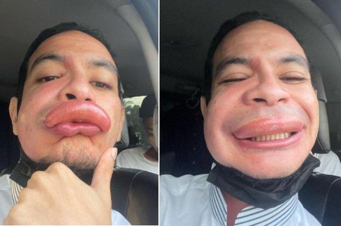 Aktor Malaysia Harris Annuar bibirnya bengkak disengat lebah.