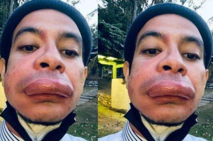 Aktor ini ceritakan pengalaman tidak menyenangkan saat bibir jontor usai cuci muka pagi-pagi.