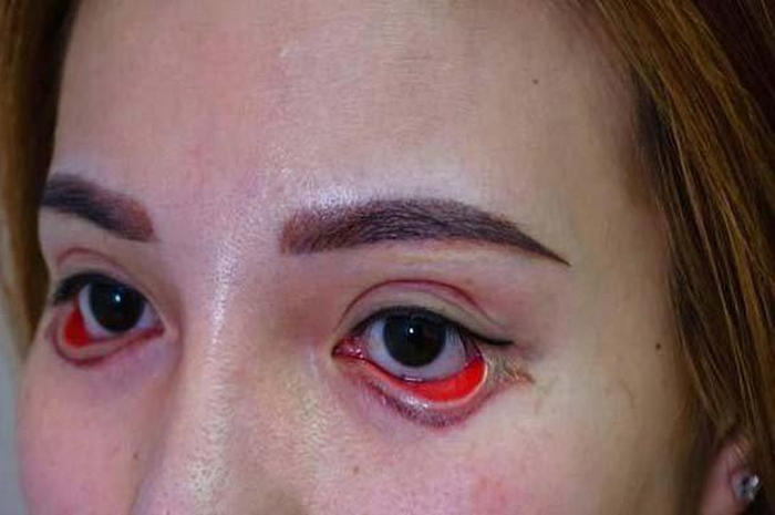 Akibat oplas ilegal wanita ini kesakitan kelopak mata tak bisa ditutup.