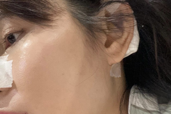 Artis yang sempat diajak bunuh diri ini sengaja membagikan foto implan operasi hidung yang jebol itu di akun Instagram pribadinya. 