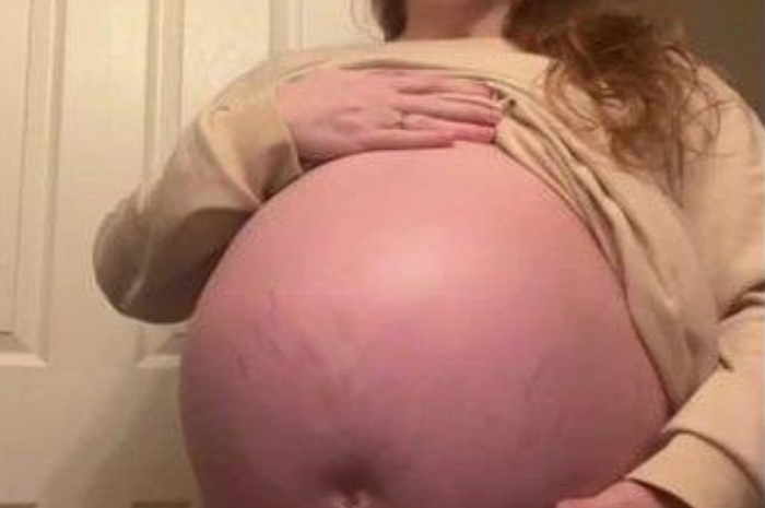Perut wanita ini membuncit terlalu besar padahal cuma mengandung satu bayi
