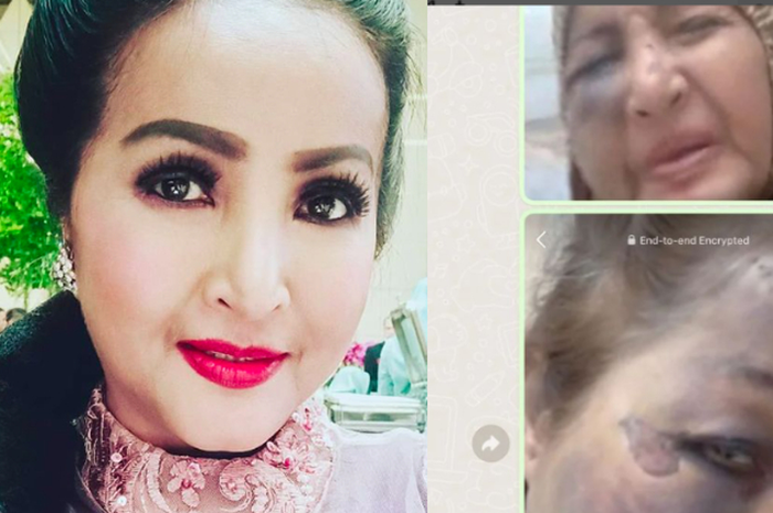 Pedangdut Machica Mochtar menjadi korban tabrak lari