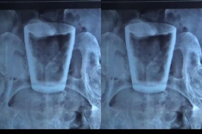Hasil foto rotgen tubuh warga Jember yang berisi gelas pecah di bagian atas 