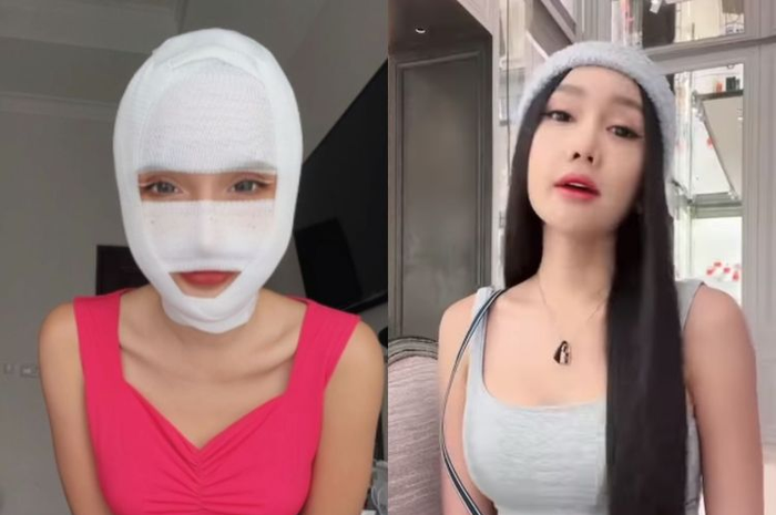  Lucinta Luna setelah jalani operasi plastik.