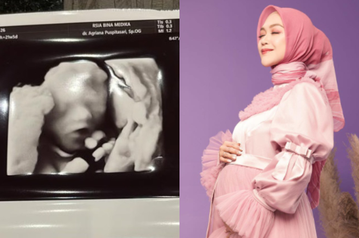 Kolase Foto USG dan Ria Ricis. 