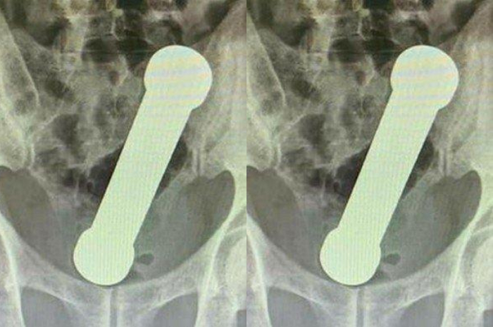 Viral pria di Brasil tancapkan barbel 2 kg ke anus, dokter sampai harus lakukan ini secara manual 
