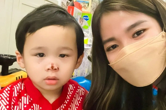 Penampilan tubuh istri Ahok, Puput Nastiti Devi ramai dibahas. Kondisi anak Puput malah bikin syok. Foto hidungnya bermasalah. 