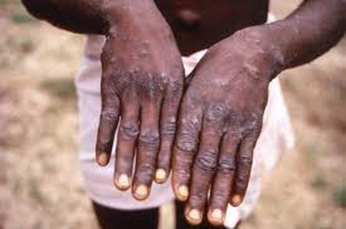 Waspada, virus monkeypox atau cacar monyet melanda