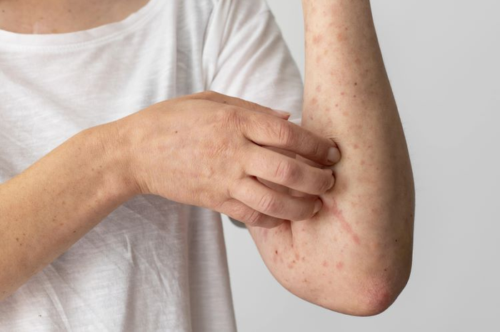 Tips hidup mencegah cacar monyet atau monkeypox agar tidak ketularan